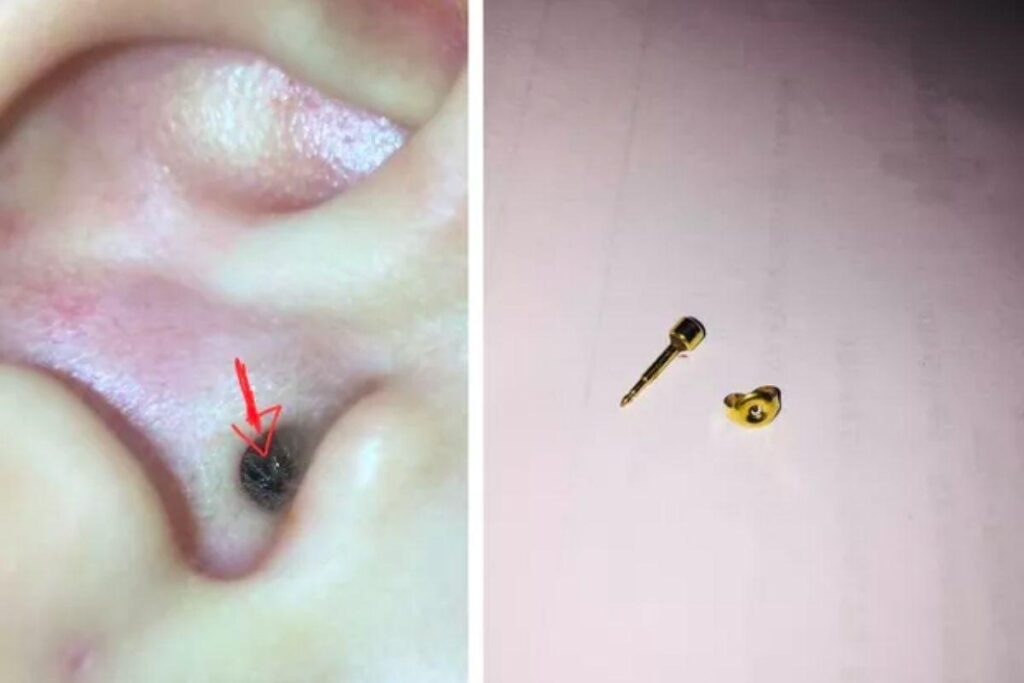 Mãe faz alerta após tarraxa de brinco entrar no ouvido da filha: “Duas semanas sem perceber”