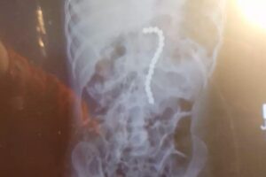 Mãe faz alerta após menino de 2 anos engolir 16 bolas magnéticas e passar por cirurgia