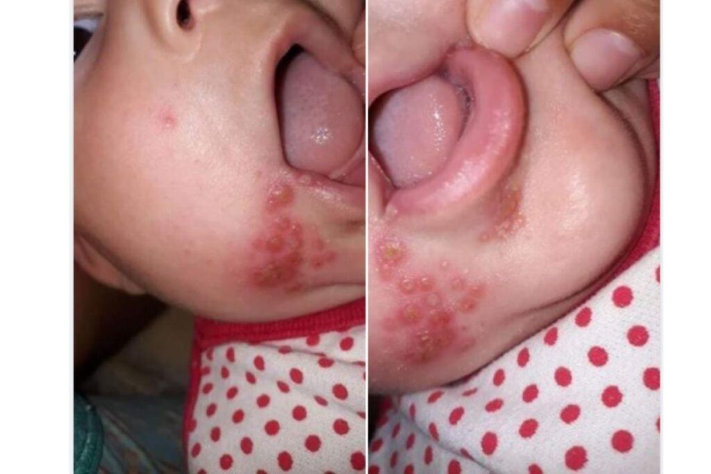 A mãe usou as redes sociais para mostrar o rosto do bebê dela com herpes e alertar outras mulheres e familiares