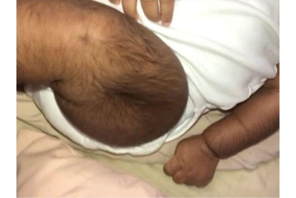 Bebê surpreende por excesso de pelos