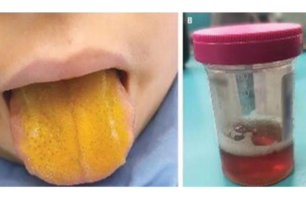 A criança foi levada ao pronto-socorro após uma série de sintomas, incluindo a língua amarelada