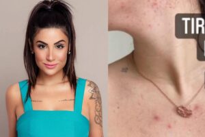 Bianca Andrade reforçou que está tranquila com a situação da pele