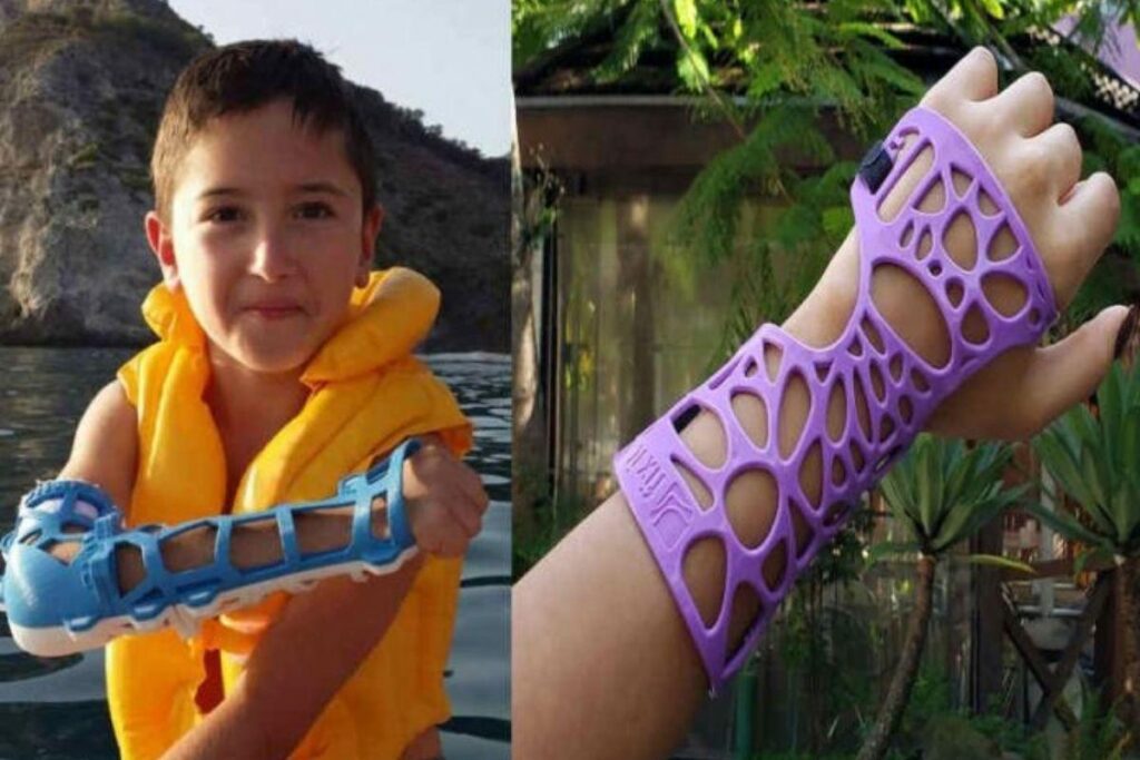 Sustentabilidade! Brasileiros criam tala de bagaço para substituir gesso