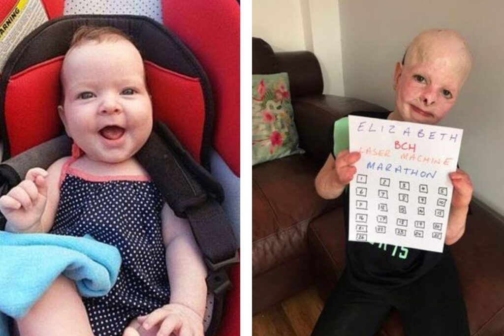 Elizabeth antes e depois das queimaduras
