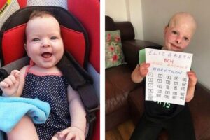 Elizabeth antes e depois das queimaduras