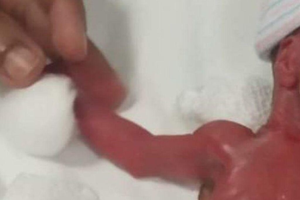 Yu Xuan nasceu com apenas 212 gramas e 24 centímetros