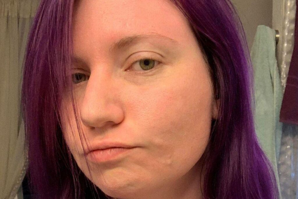 River tem alergia ao sol e é fotossensível