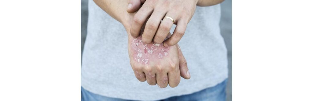 É muito importante conscientizar sobre a doença