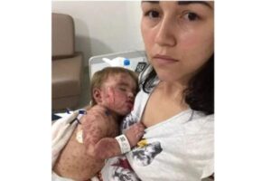 Helena, de apenas 1 ano de idade, sofreu graves queimaduras