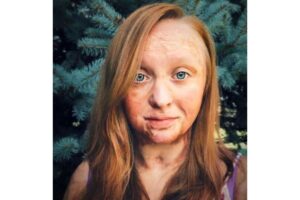 Charity Sutter com o cicatrizes de queimadura de terceiro grau aos 4 anos