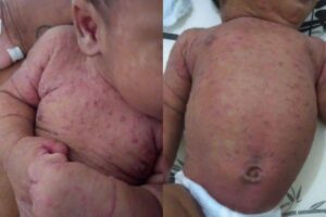 Um bebê de dois meses foi internado após se contaminar com sarna humana