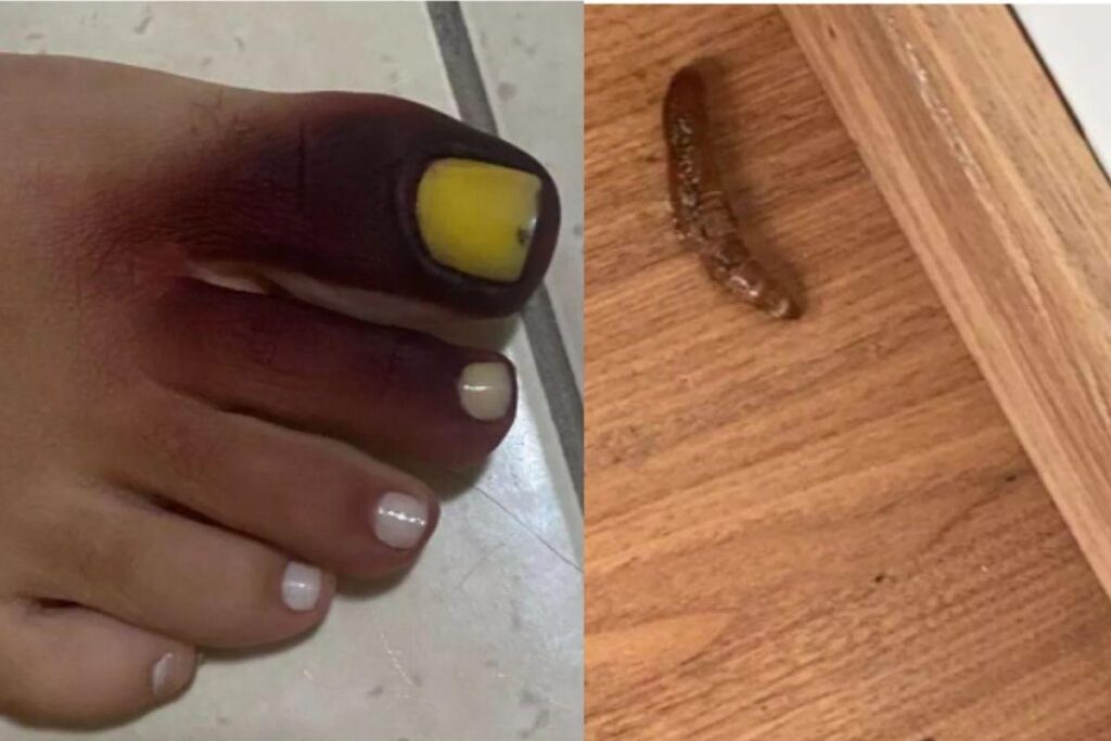 Pé após ser picado por pilho-de-cobra