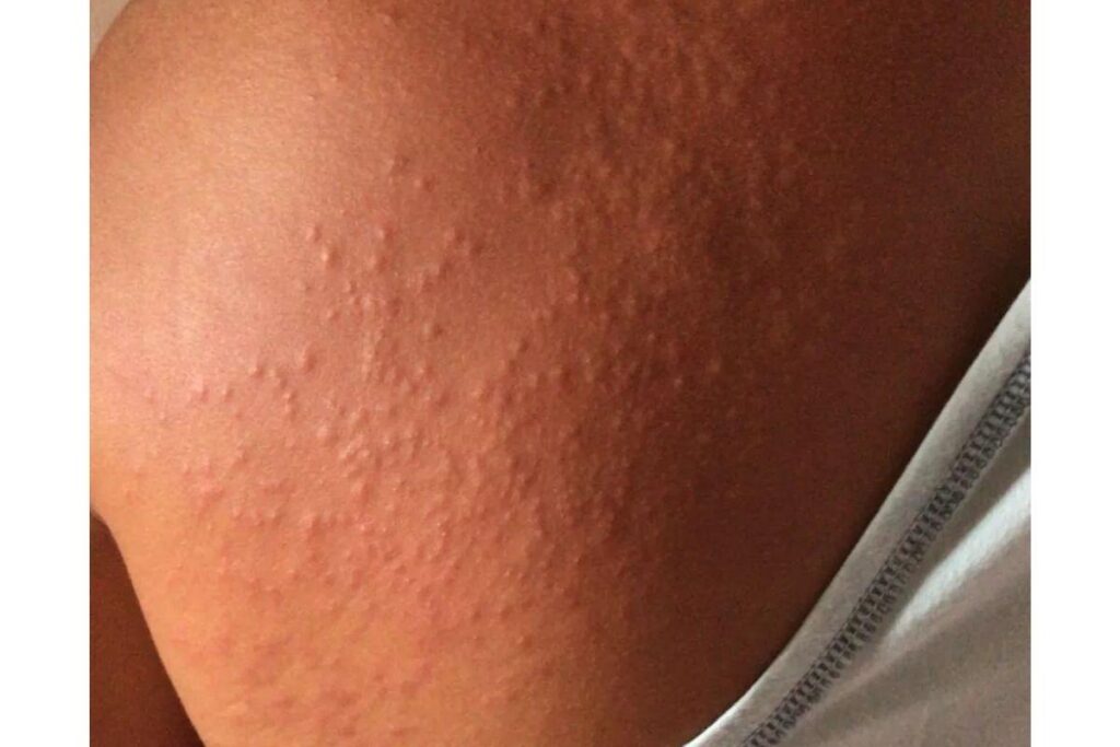 Não era “sarna humana”! Especialistas explicam o que causou surto lesões com coceira em Pernambuco