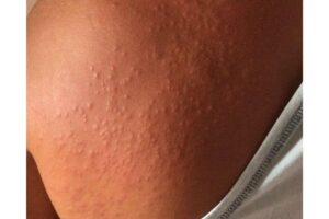 Não era “sarna humana”! Especialistas explicam o que causou surto lesões com coceira em Pernambuco