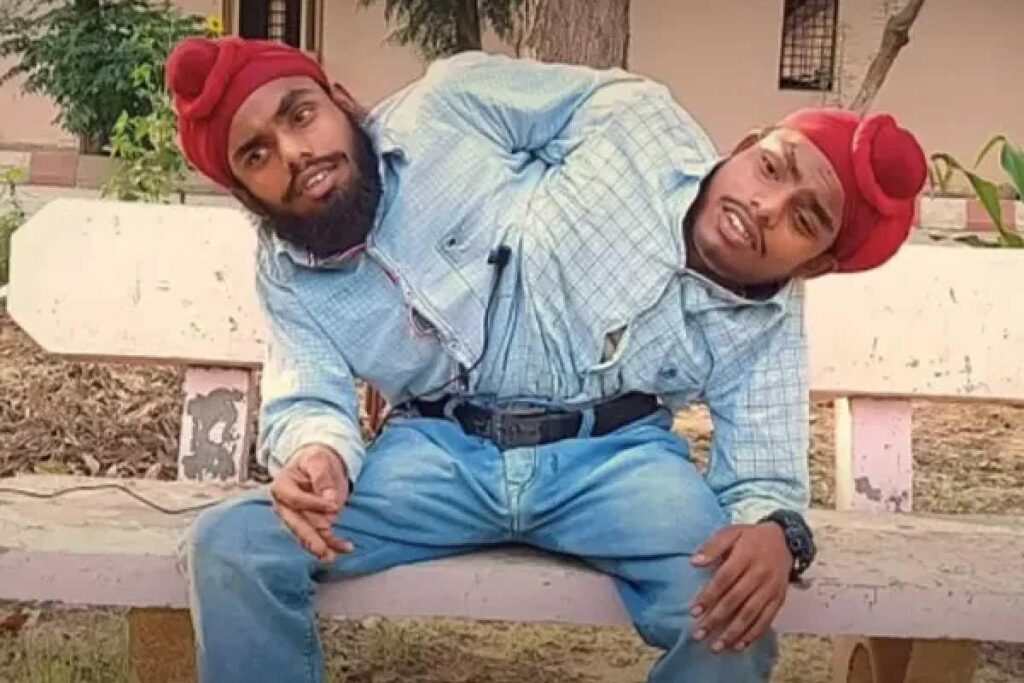 Os irmãos siameses falaram sobre o primeiro emprego