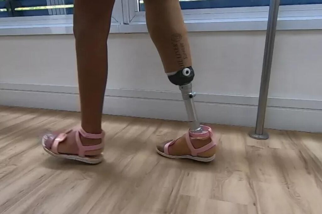 Graças à nova prótese, Júlia voltou a brincar como as demais crianças