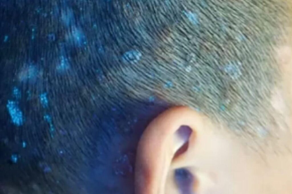 Menino fica com couro cabeludo brilhante após ser infectado por fungos