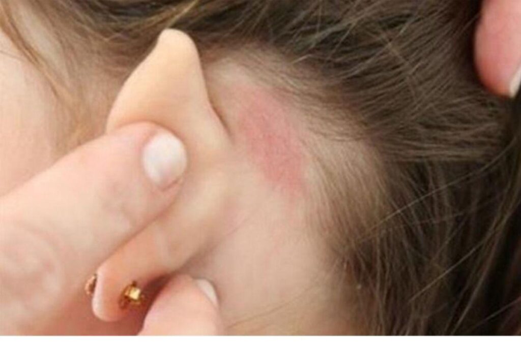 Dia Mundial da Hanseníase