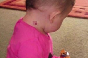 A bebê nascida no Dia dos Namorados possuía uma marca de nascença em formato de coração