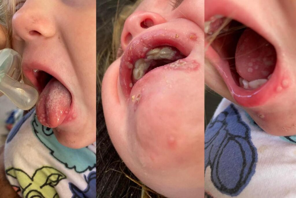 Leah explicou que o menor toque faria as manchas sangrarem e seu bebê gritaria de agonia