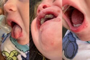 Leah explicou que o menor toque faria as manchas sangrarem e seu bebê gritaria de agonia