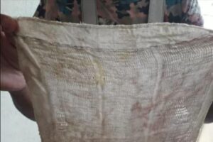 Mulher encontra pedaço de pano esquecido dentro do corpo 6 meses após cesárea