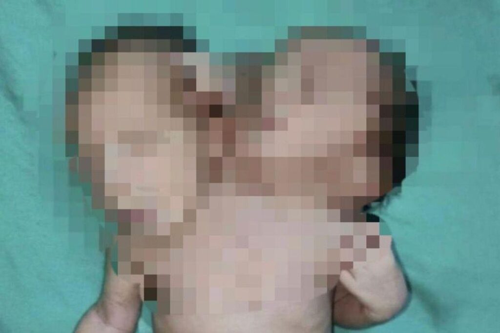 Gêmeos siameses nascem com duas cabeças e três braços em caso raro