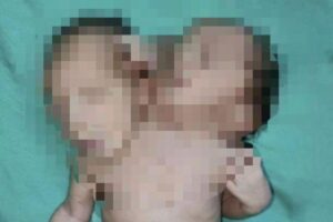 Gêmeos siameses nascem com duas cabeças e três braços em caso raro