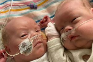 Os gêmeos prematuros nasceram com 5 meses de gestação e precisaram passar por 6 cirurgias e 25 transfusões de sangue