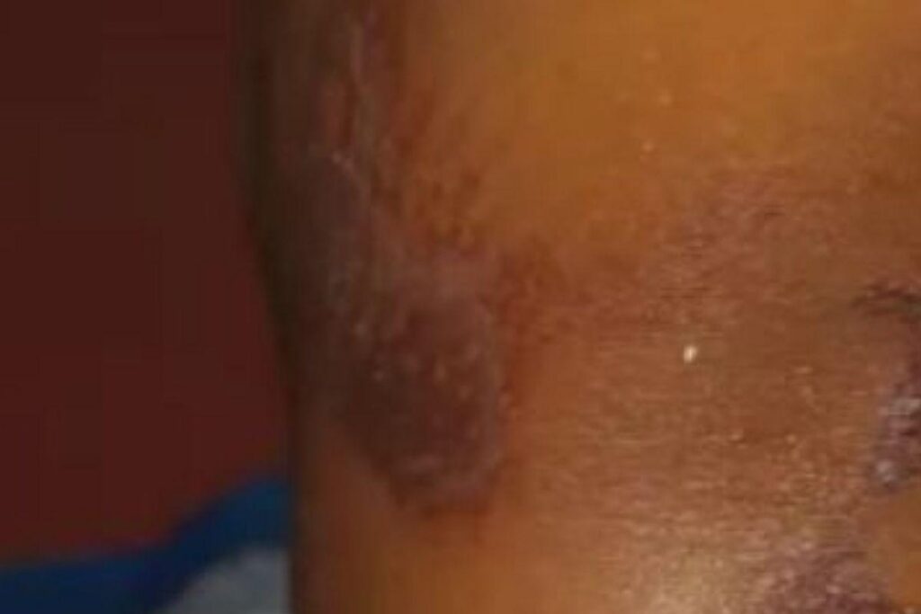 A mãe queimava a filha com colher quente