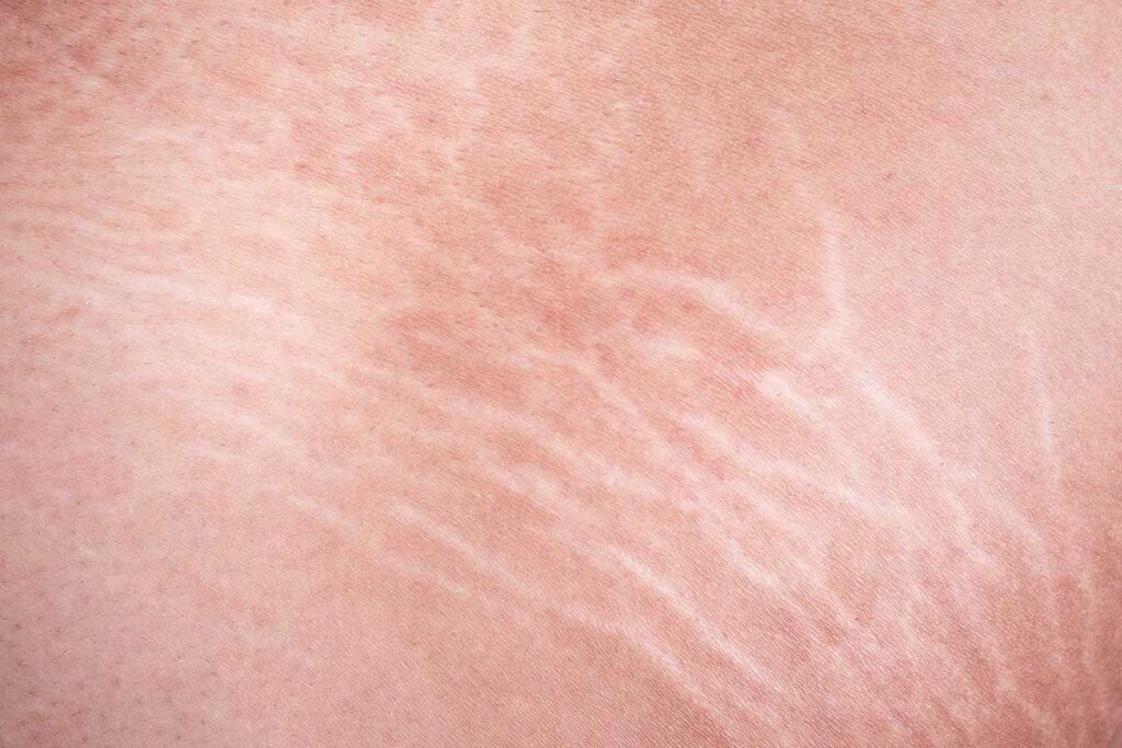 As estrias são lesões na pele que acontecem por causa do rompimento das fibras colágenas e elásticas, que são responsáveis por dar firmeza à pele.