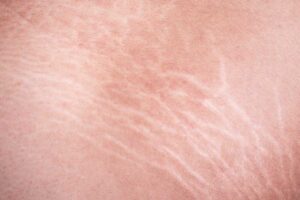 As estrias são lesões na pele que acontecem por causa do rompimento das fibras colágenas e elásticas, que são responsáveis por dar firmeza à pele.