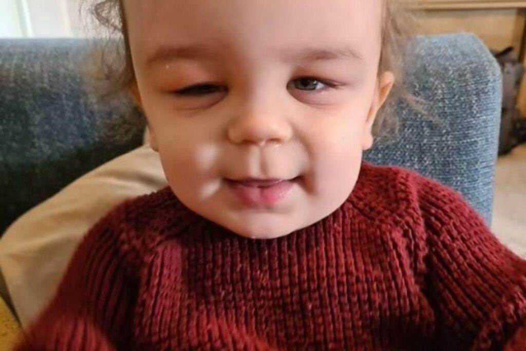 O bebê nasceu com um condição rara chamada ‘cranioestenose’