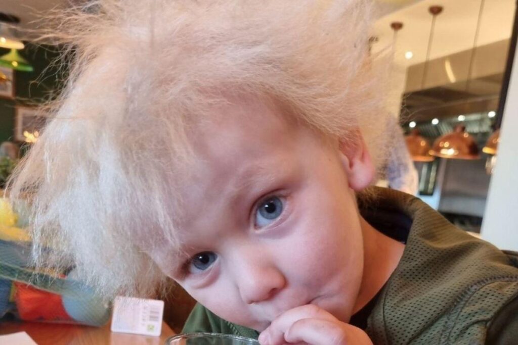 O menino sofre da Síndrome do Cabelo Impenteável
