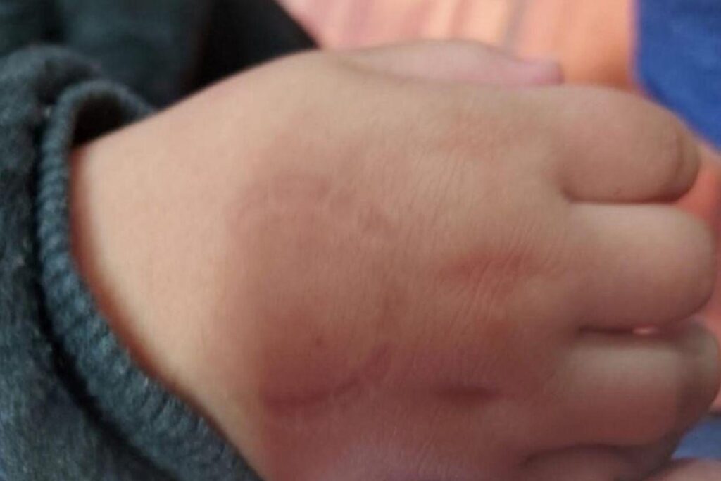 Diretora de escola teria mordido criança de 4 anos