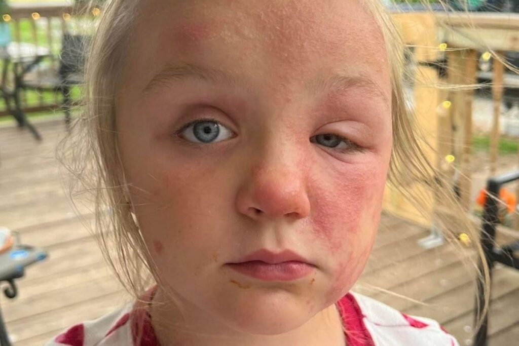 A criança ficou com diversas erupções na pele, por conta da reação alérgica