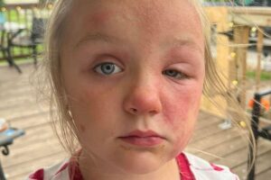 A criança ficou com diversas erupções na pele, por conta da reação alérgica