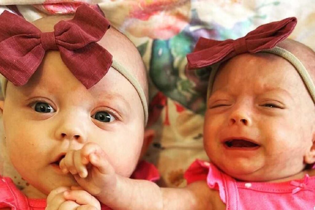 Gêmea nasce com o triplo do tamanho da irmã e mãe conta história de superação