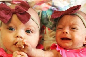 Gêmea nasce com o triplo do tamanho da irmã e mãe conta história de superação