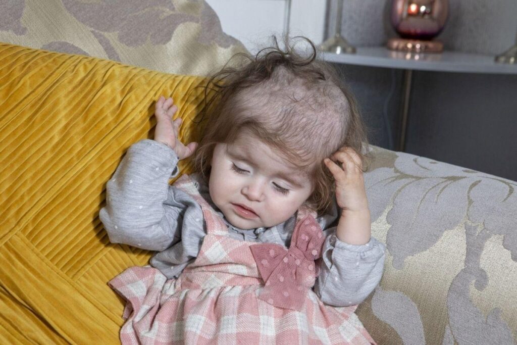 Sydney Miller tem doença rara e arranca o próprio cabelo para comer