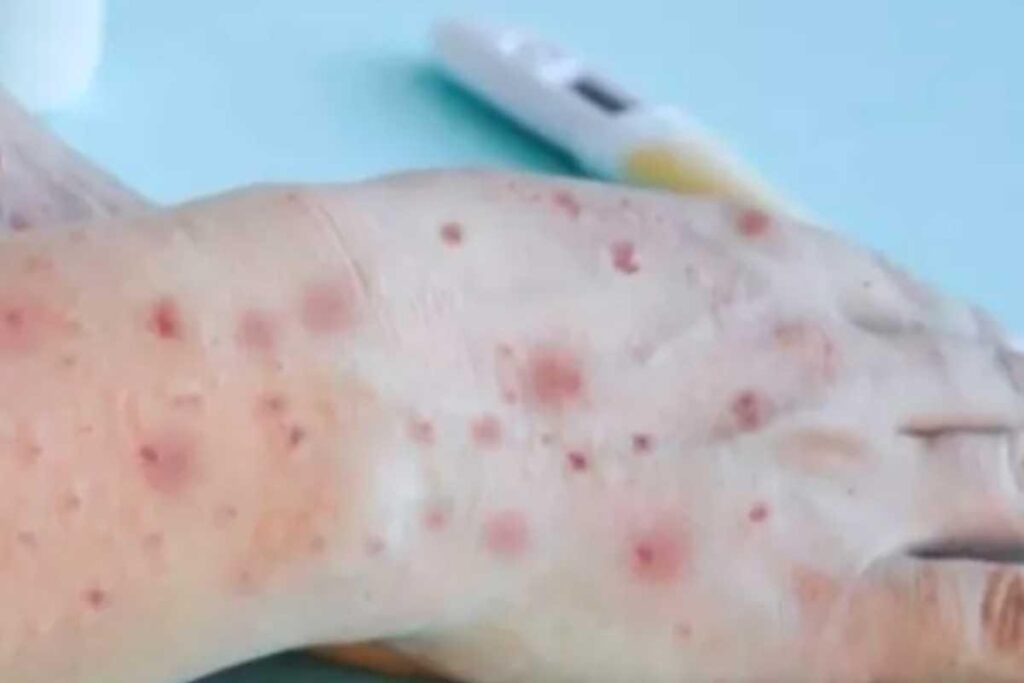 Brasil é o sexto país com maior número de casos da Varíola dos Macacos
