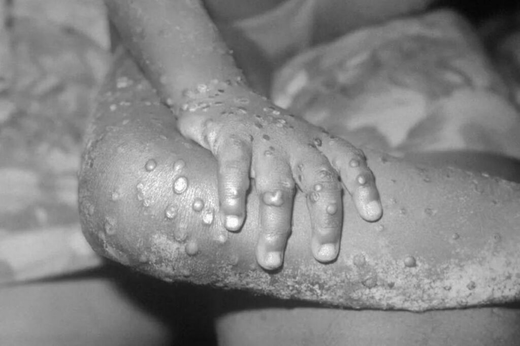 OMS define situação de emergência para varíola dos macacos