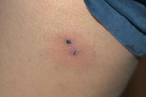 O menino de nove anos foi mordido pelo rato na escola