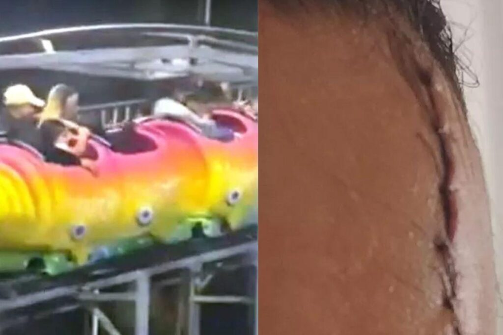 Além dos pontos, a mulher ficou com o braço roxo