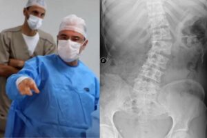 Escoliose infantil grave poderá ser trata por dispositivo que acompanha alongamento da coluna