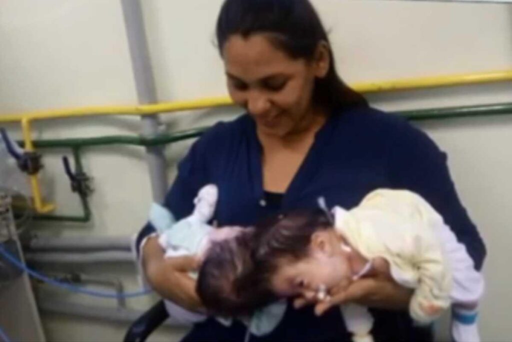 Cirurgia de gêmeos siameses é considerada um sucesso