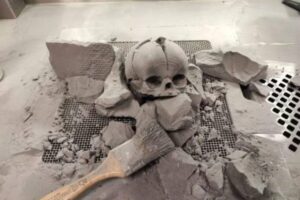 A bebê poderia ter morrido sem a operação por alguma infecção dada à exposição do tecido cerebral