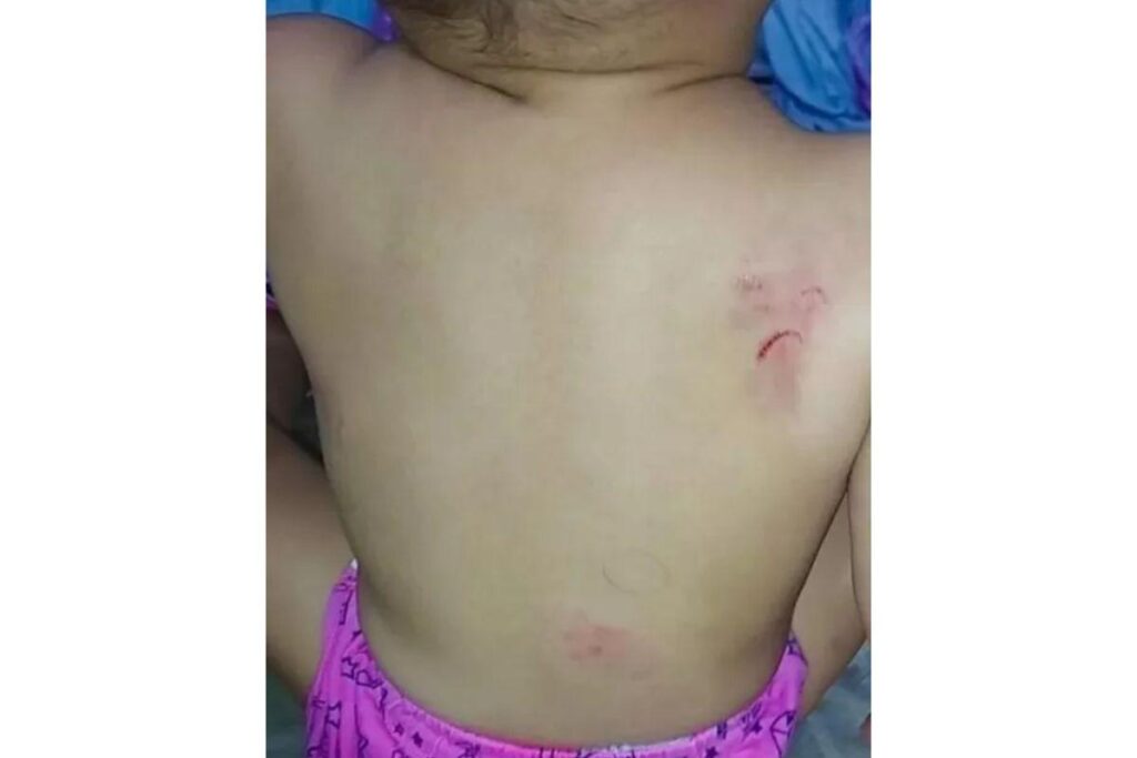 A mãe buscou a criança na creche quando percebeu as marcas