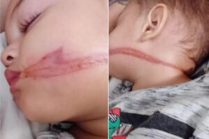 Os bebês ficaram feridos após serem atingidos pelos fios