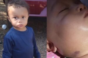 Benjamin foi levado ao hospital com inchaço no pescoço